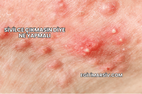 Sivilce Çıkmasın Diye Ne Yapmalı