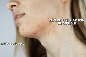 Sivilce Çukurları İçin Ne Yapmalı?