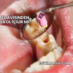 Kanal Tedavisinden Sonra Alkol İçilir mi?