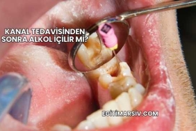 Kanal Tedavisinden Sonra Alkol İçilir mi?