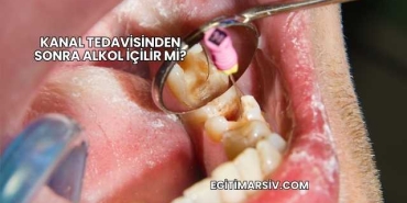 Kanal Tedavisinden Sonra Alkol İçilir mi?