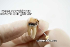 Kanal Tedavisinden Sonra Sıcak İçilir mi?