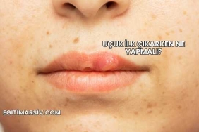 Uçuk İlk Çıkarken Ne Yapmalı?