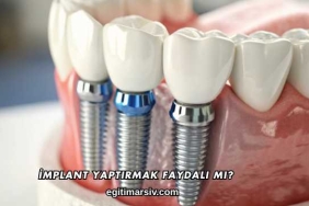 İmplant Yaptırmak Faydalı mı?