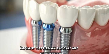 İmplant Yaptırmak Faydalı mı?