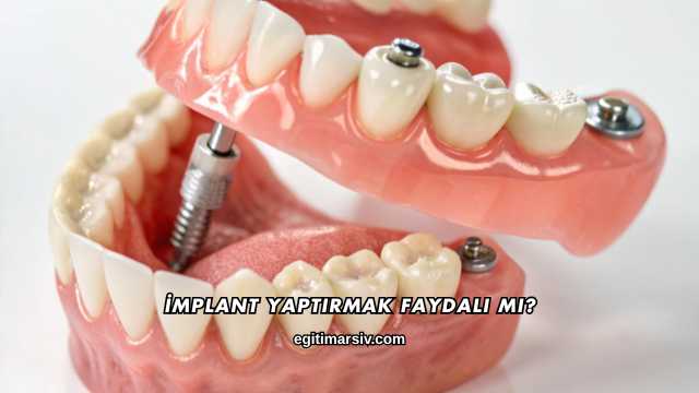 İmplant Yaptırmak Faydalı mı?