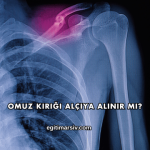 Omuz Kırığı Alçıya Alınır mı?
